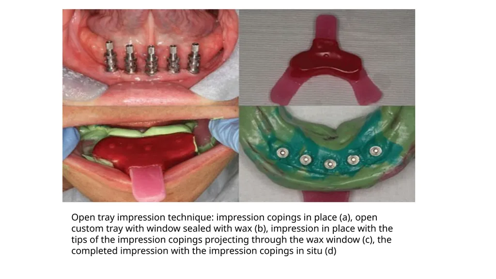 IMPRESSION IN IMPLANT DENTISTRY Presented by :Dr. - slide 29 of 38