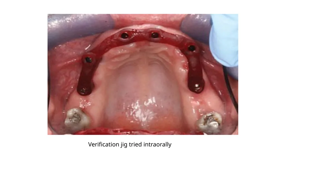 IMPRESSION IN IMPLANT DENTISTRY Presented by :Dr. - slide 36 of 38