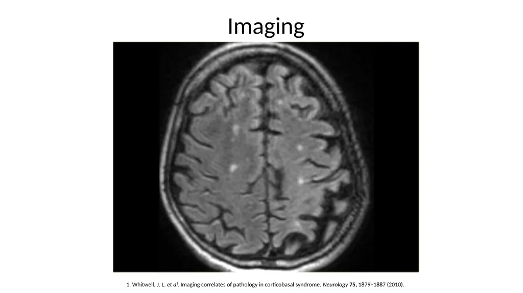 Diagnosing and Managing PSP & CBS Dr Boyd Ghosh - slide 43 of 54