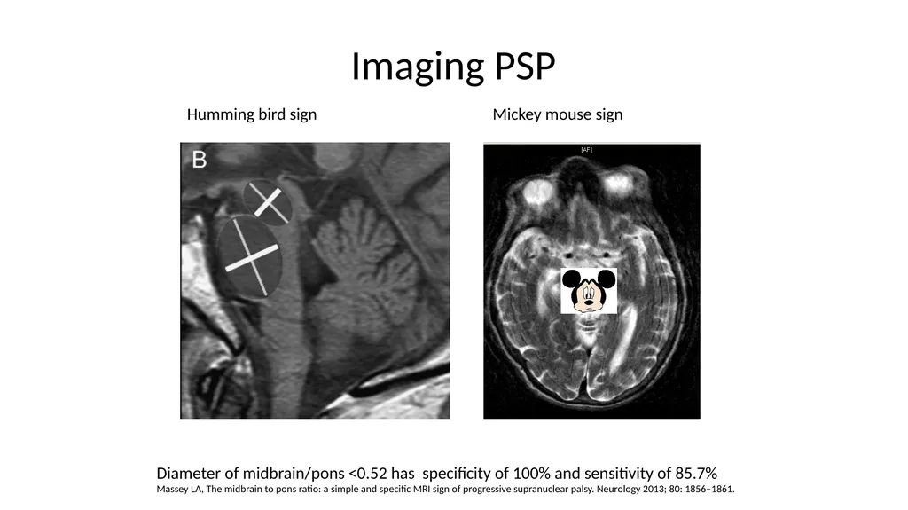 Diagnosing and Managing PSP & CBS Dr Boyd Ghosh - slide 20 of 54