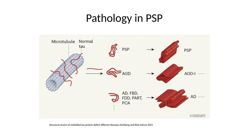 Diagnosing and Managing PSP & CBS Dr Boyd Ghosh - slide 46 of 54