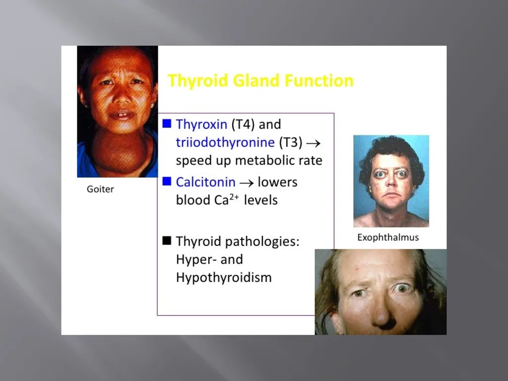THYROID GLAND –part 3 disorders DR. SHEETAL JAIN - slide 12 of 40