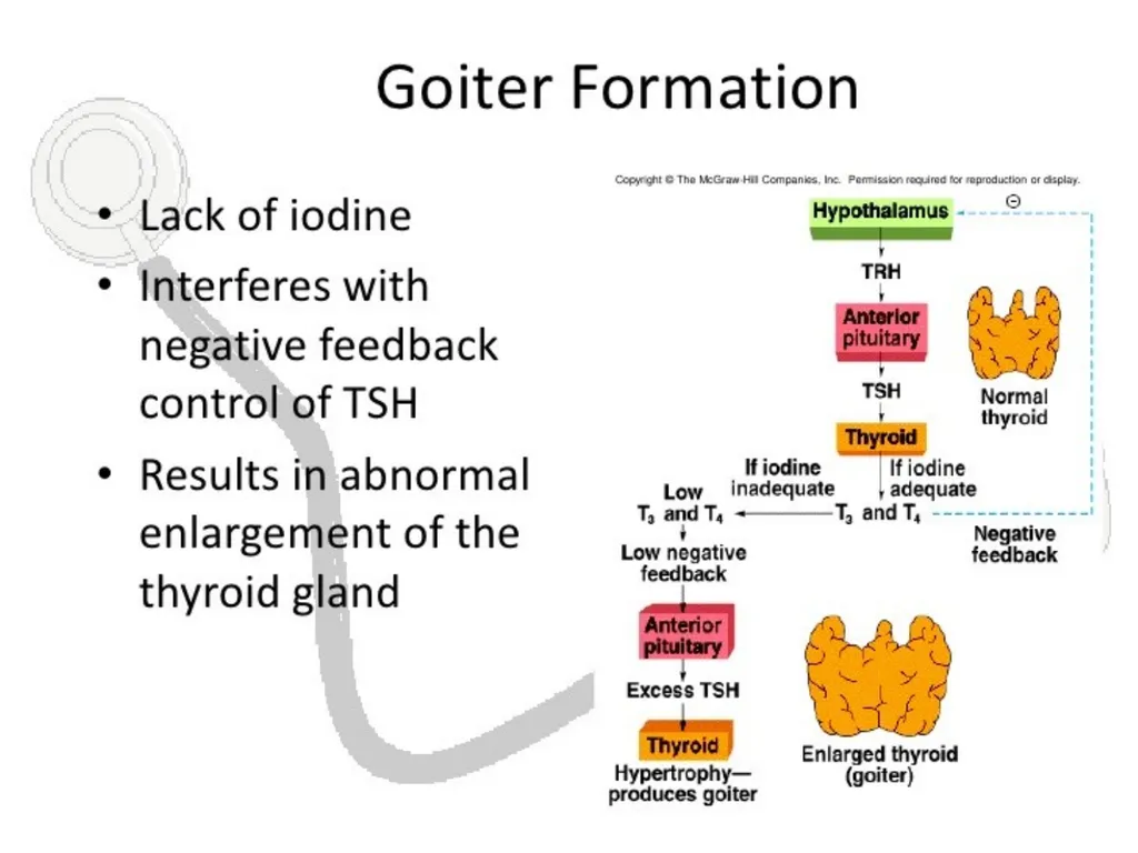 THYROID GLAND –part 3 disorders DR. SHEETAL JAIN - slide 13 of 40