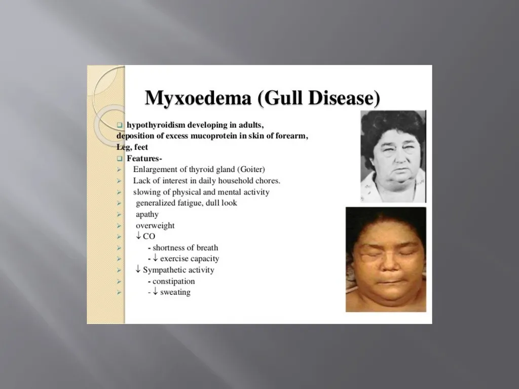 THYROID GLAND –part 3 disorders DR. SHEETAL JAIN - slide 18 of 40