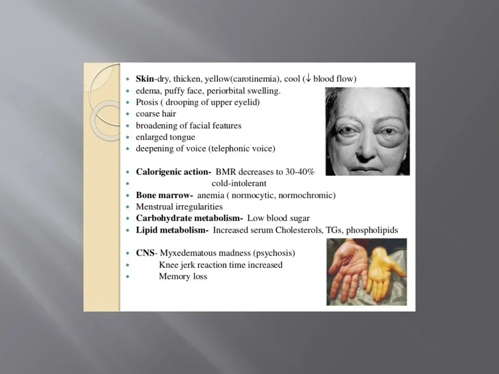 THYROID GLAND –part 3 disorders DR. SHEETAL JAIN - slide 19 of 40