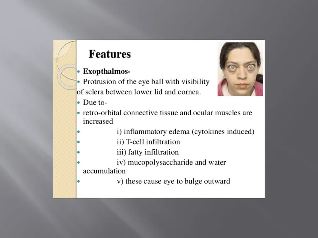 THYROID GLAND –part 3 disorders DR. SHEETAL JAIN - slide 29 of 40
