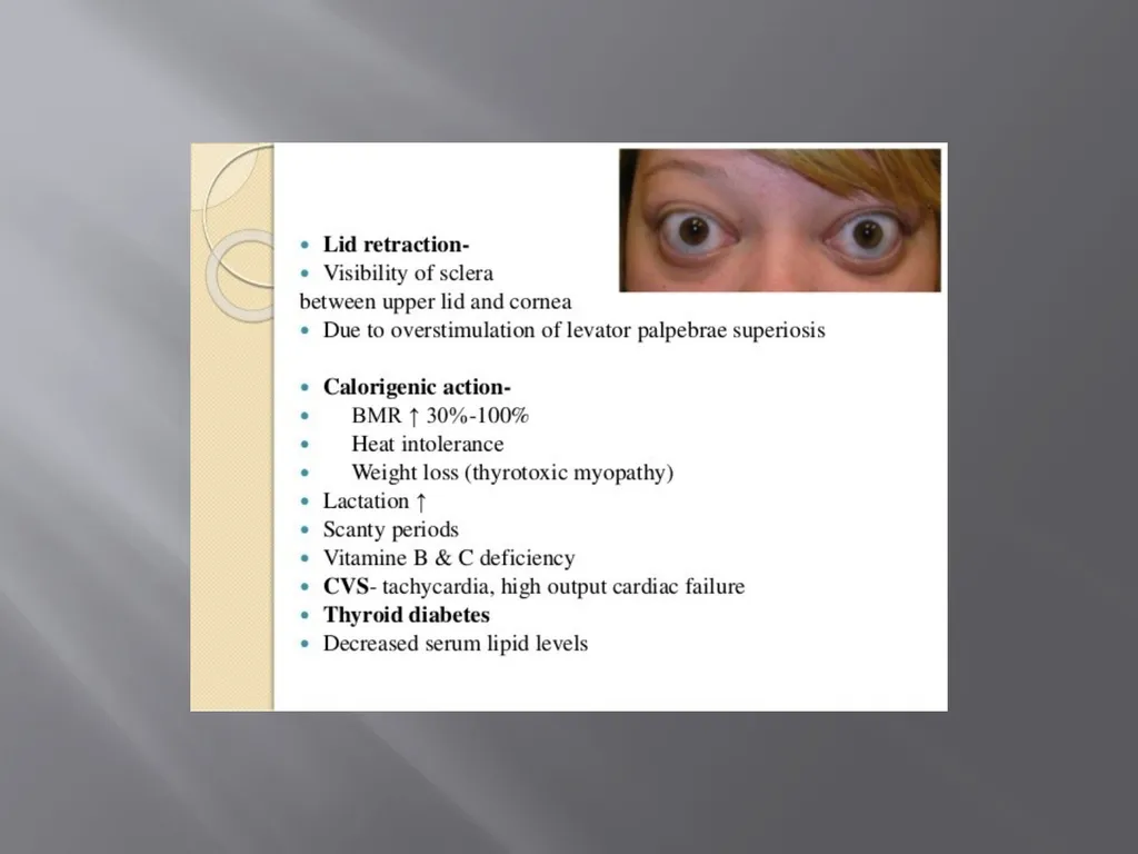 THYROID GLAND –part 3 disorders DR. SHEETAL JAIN - slide 30 of 40