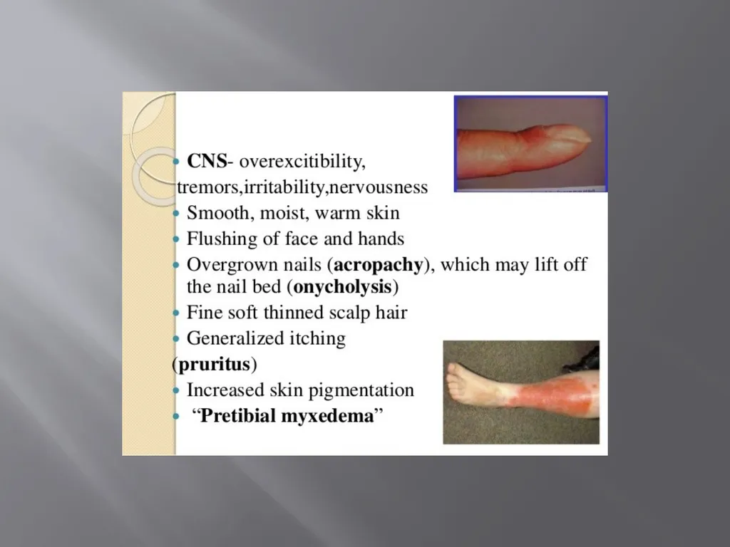 THYROID GLAND –part 3 disorders DR. SHEETAL JAIN - slide 31 of 40