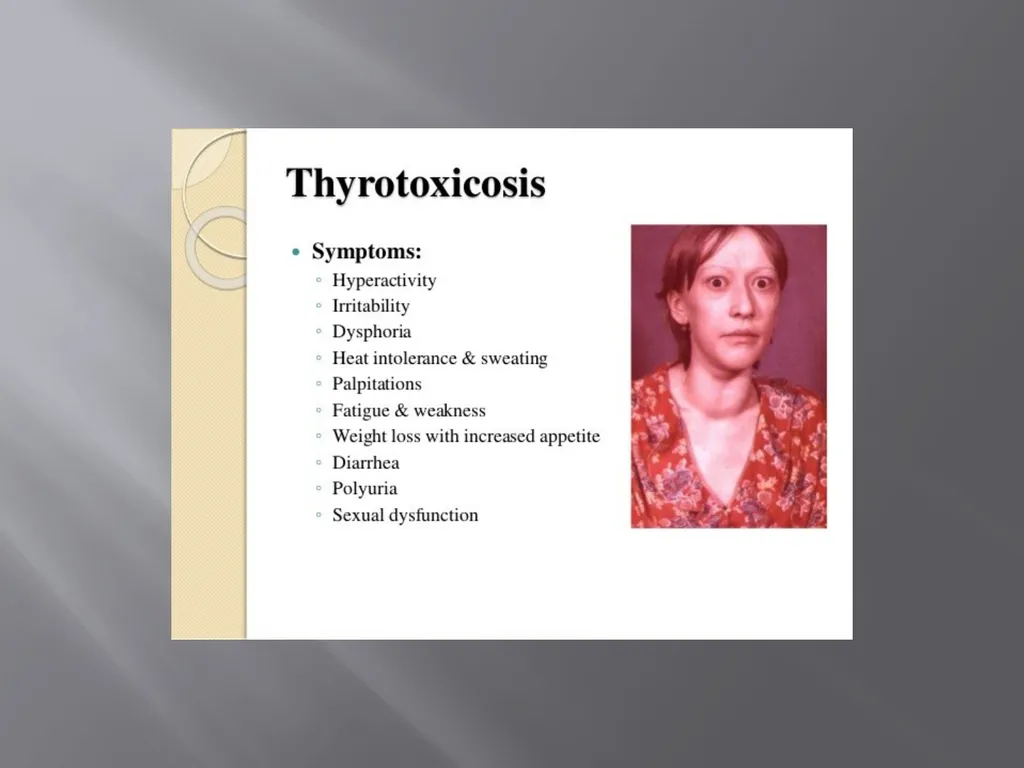 THYROID GLAND –part 3 disorders DR. SHEETAL JAIN - slide 32 of 40