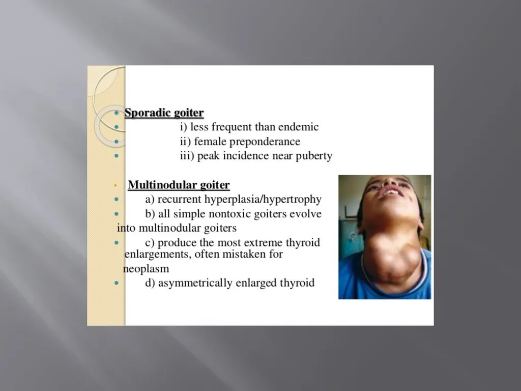 THYROID GLAND –part 3 disorders DR. SHEETAL JAIN - slide 37 of 40