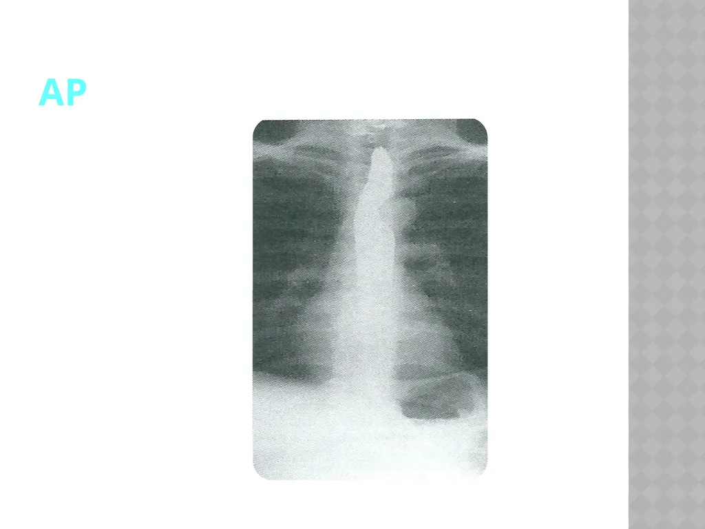 Barium Swallow Meaad AlMusined Introduction - slide 7 of 12