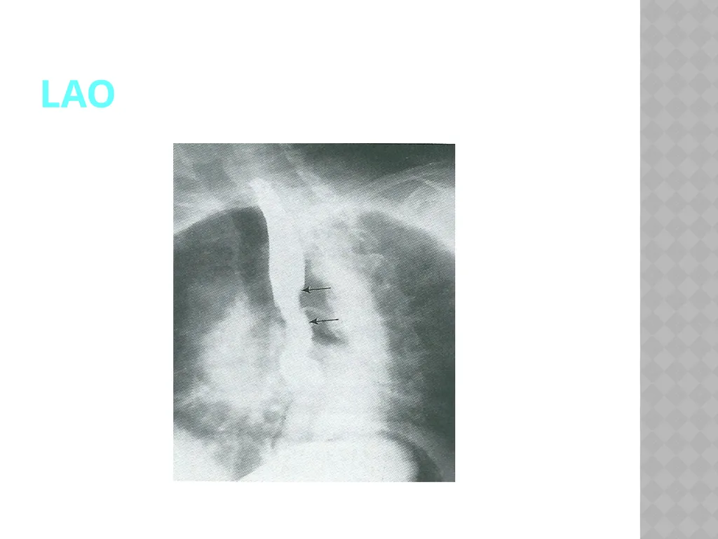 Barium Swallow Meaad AlMusined Introduction - slide 11 of 12