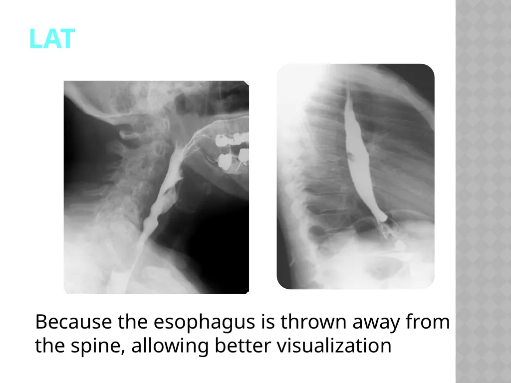 Barium Swallow Meaad AlMusined Introduction - slide 8 of 12