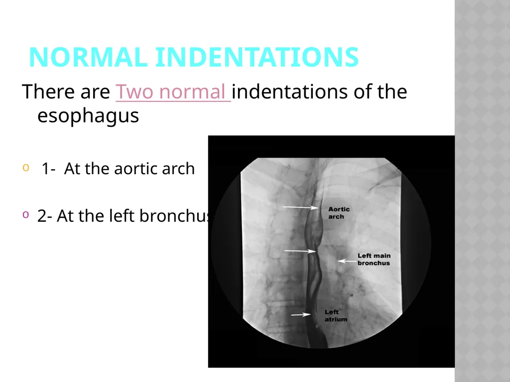 Barium Swallow Meaad AlMusined Introduction - slide 5 of 12