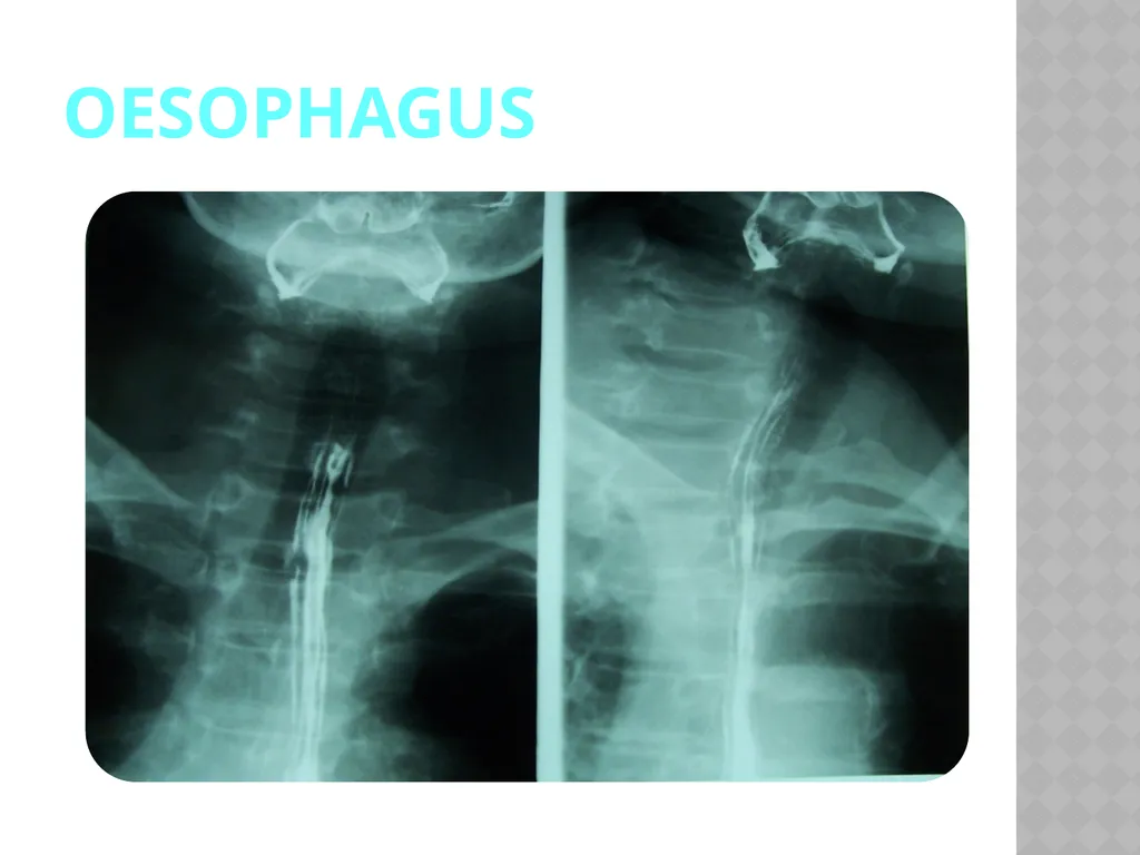 Barium Swallow Meaad AlMusined Introduction - slide 4 of 12