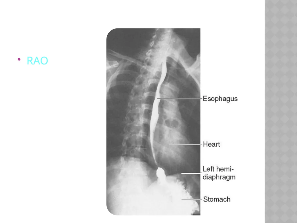 Barium Swallow Meaad AlMusined Introduction - slide 10 of 12