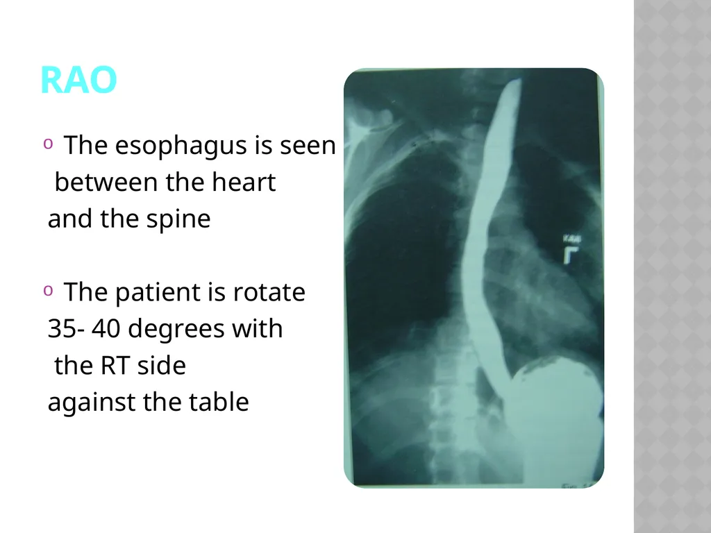 Barium Swallow Meaad AlMusined Introduction - slide 9 of 12