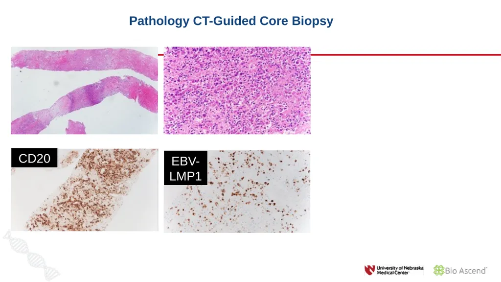 Diffuse Large B-cell Lymphoma November 10, 2021 - slide 15 of 71