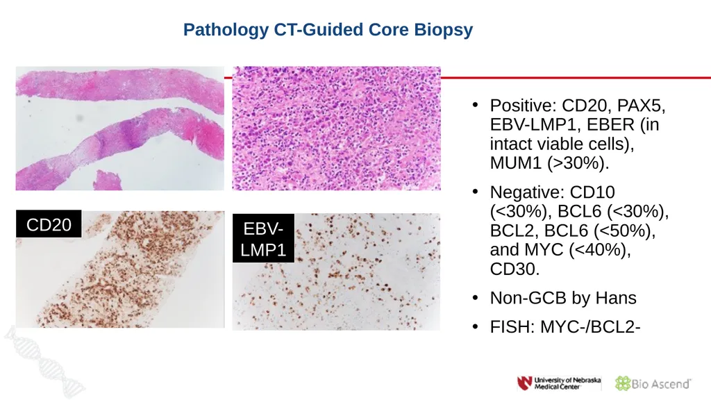 Diffuse Large B-cell Lymphoma November 10, 2021 - slide 16 of 71