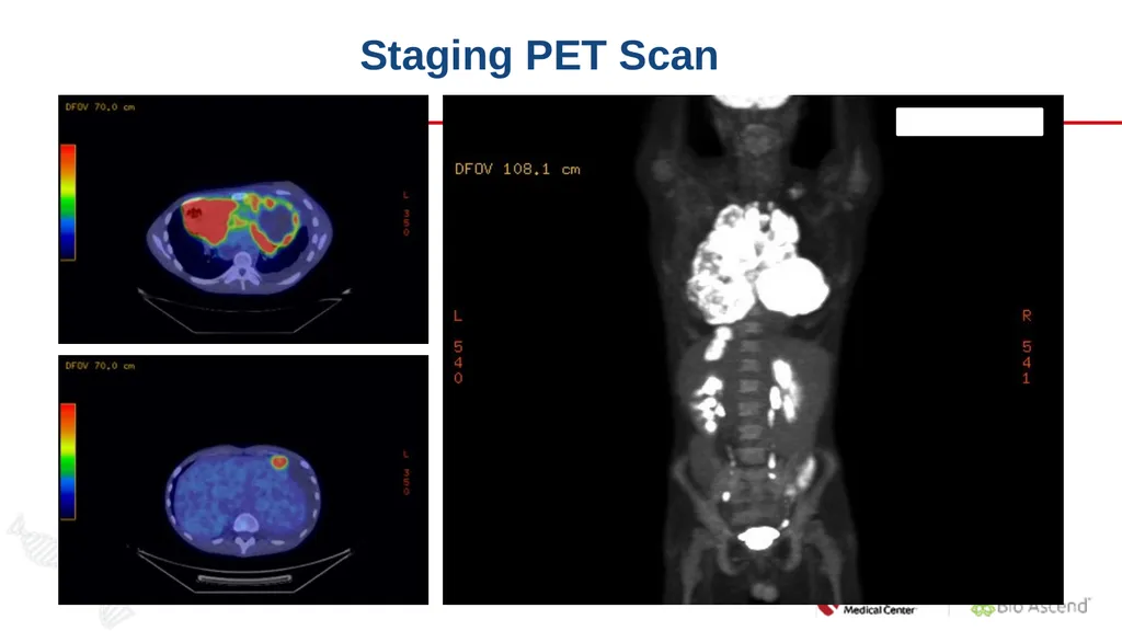 Diffuse Large B-cell Lymphoma November 10, 2021 - slide 14 of 71