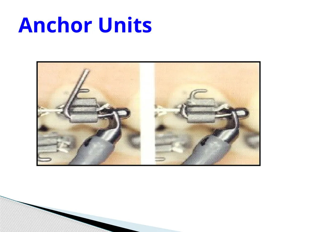 Fixed Functional Appliances Introduction - slide 26 of 48