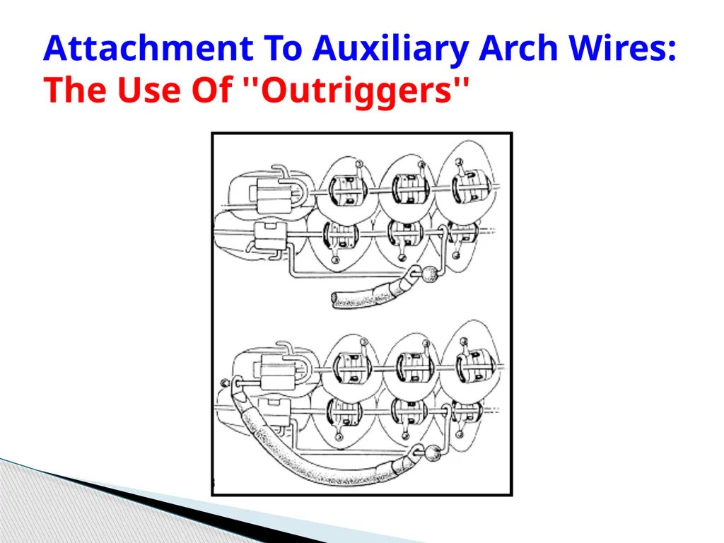 Fixed Functional Appliances Introduction - slide 28 of 48