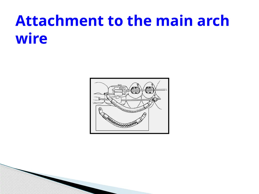 Fixed Functional Appliances Introduction - slide 27 of 48