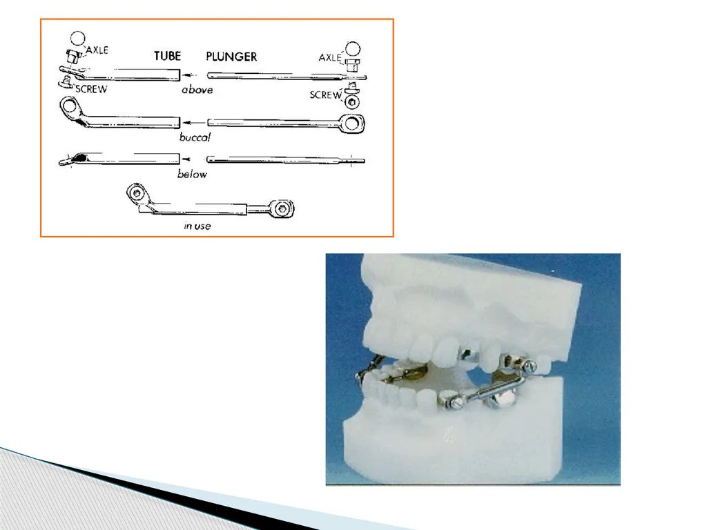 Fixed Functional Appliances Introduction - slide 15 of 48