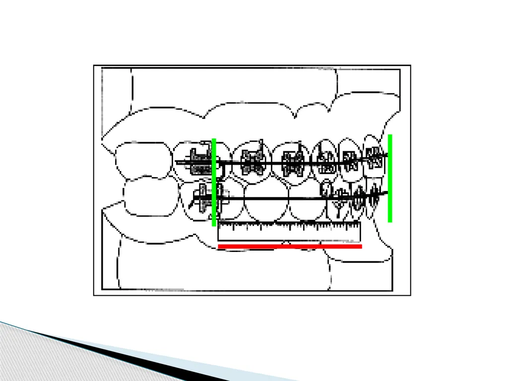 Fixed Functional Appliances Introduction - slide 36 of 48