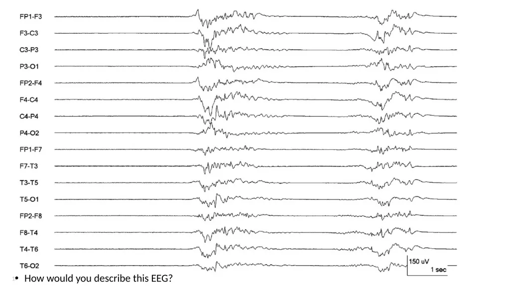ACNS Critical Care EEG Terminology Training Module - slide 16 of 41