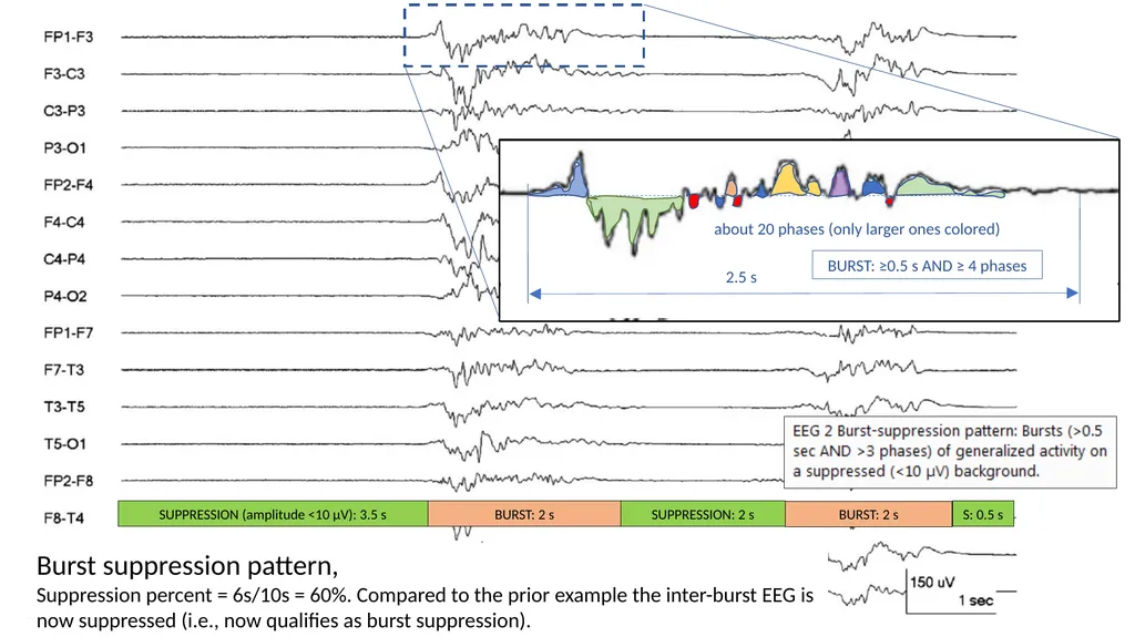 ACNS Critical Care EEG Terminology Training Module - slide 17 of 41