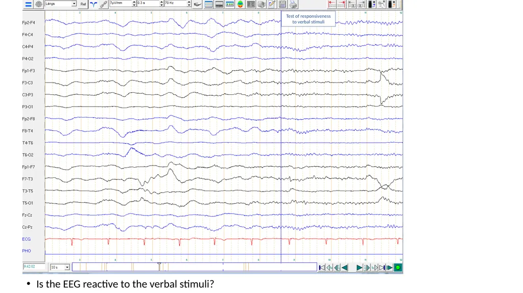 ACNS Critical Care EEG Terminology Training Module - slide 29 of 41