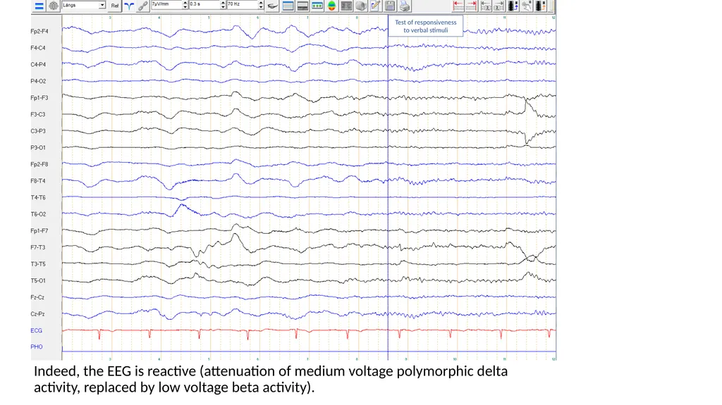 ACNS Critical Care EEG Terminology Training Module - slide 30 of 41