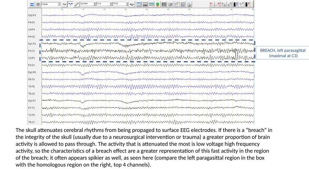 ACNS Critical Care EEG Terminology Training Module - slide 35 of 41