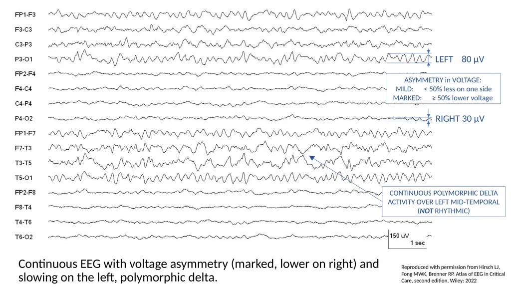 ACNS Critical Care EEG Terminology Training Module - slide 10 of 41
