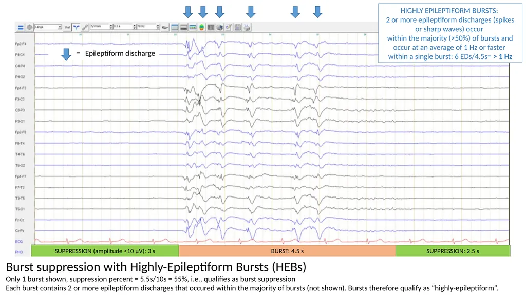 ACNS Critical Care EEG Terminology Training Module - slide 23 of 41