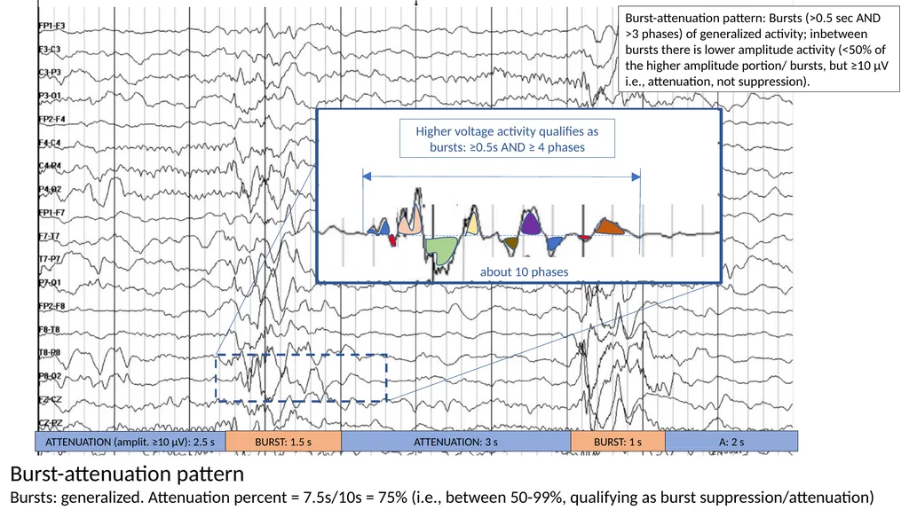 ACNS Critical Care EEG Terminology Training Module - slide 14 of 41