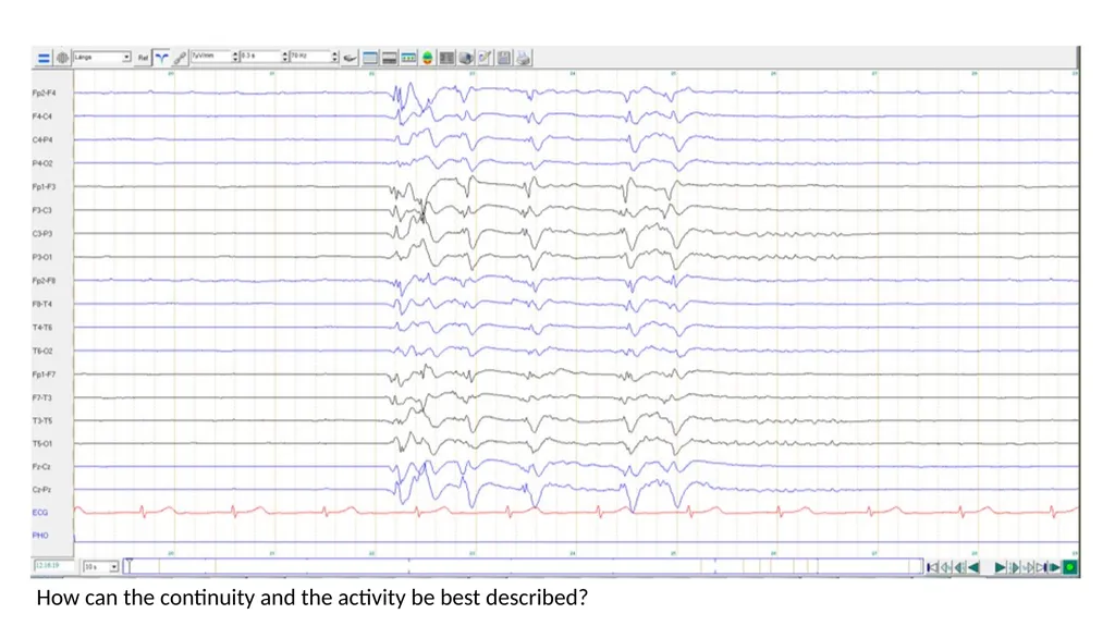 ACNS Critical Care EEG Terminology Training Module - slide 22 of 41
