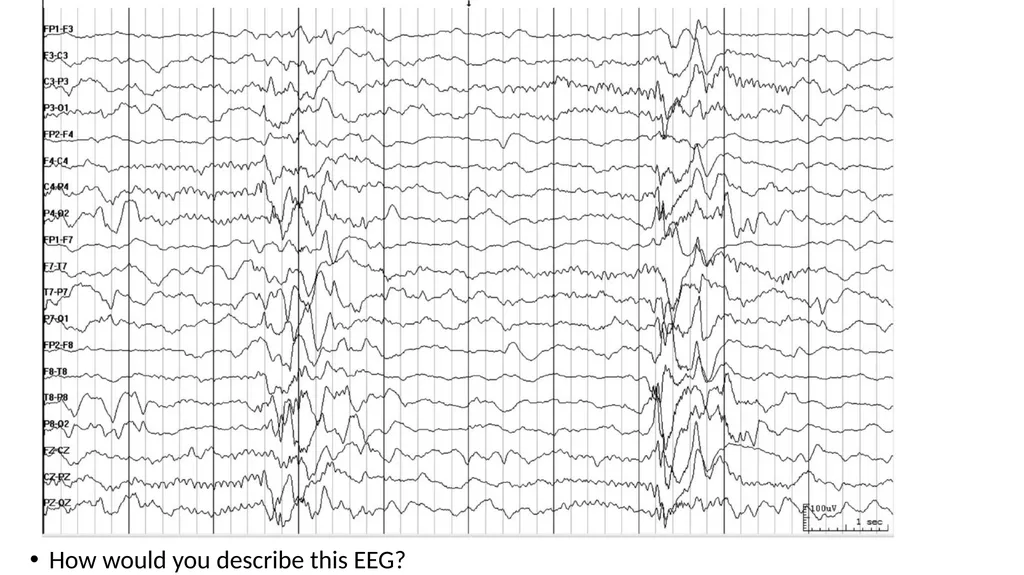 ACNS Critical Care EEG Terminology Training Module - slide 13 of 41