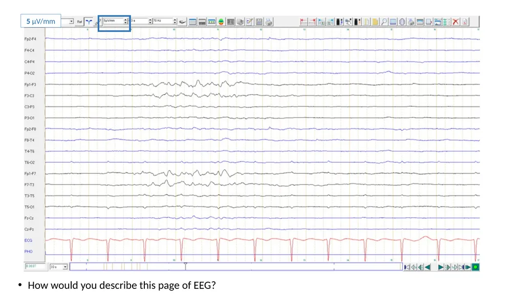 ACNS Critical Care EEG Terminology Training Module - slide 18 of 41