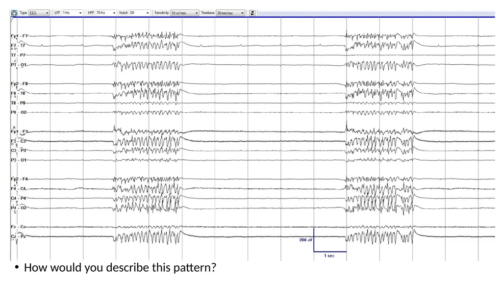 ACNS Critical Care EEG Terminology Training Module - slide 26 of 41
