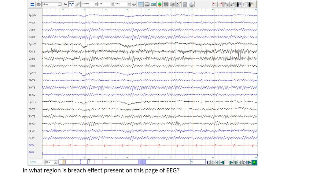 ACNS Critical Care EEG Terminology Training Module - slide 34 of 41