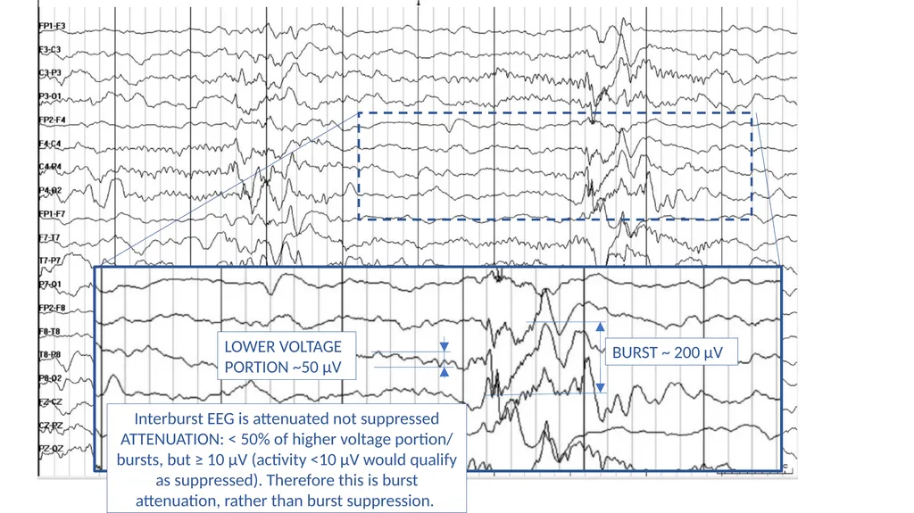 ACNS Critical Care EEG Terminology Training Module - slide 15 of 41