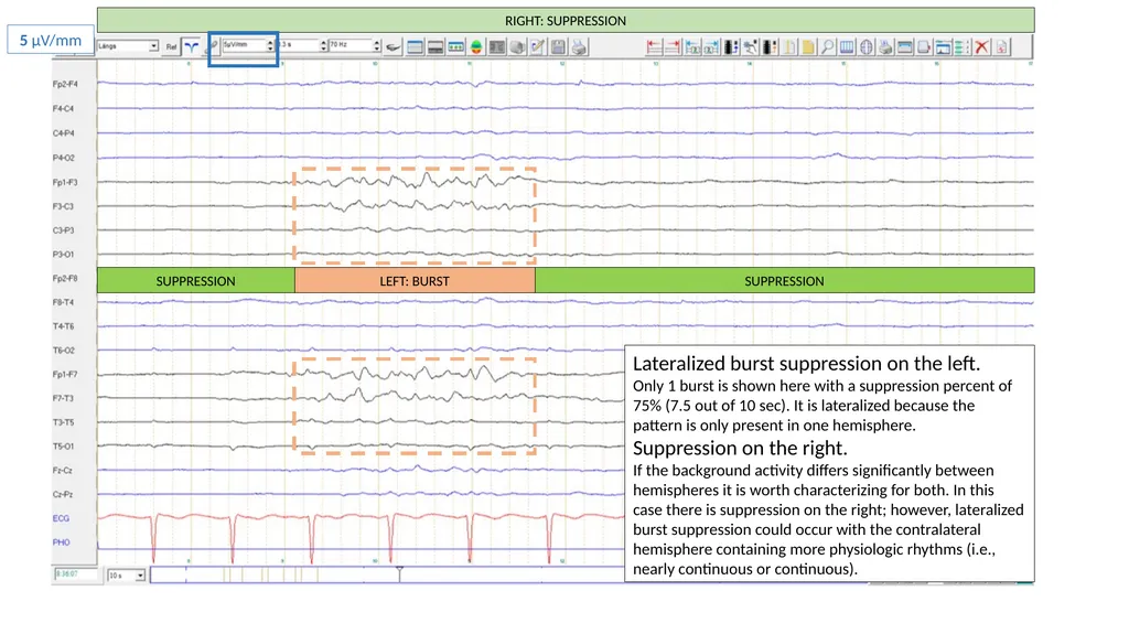 ACNS Critical Care EEG Terminology Training Module - slide 19 of 41