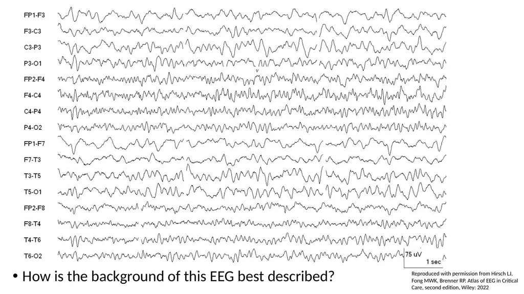 ACNS Critical Care EEG Terminology Training Module - slide 11 of 41