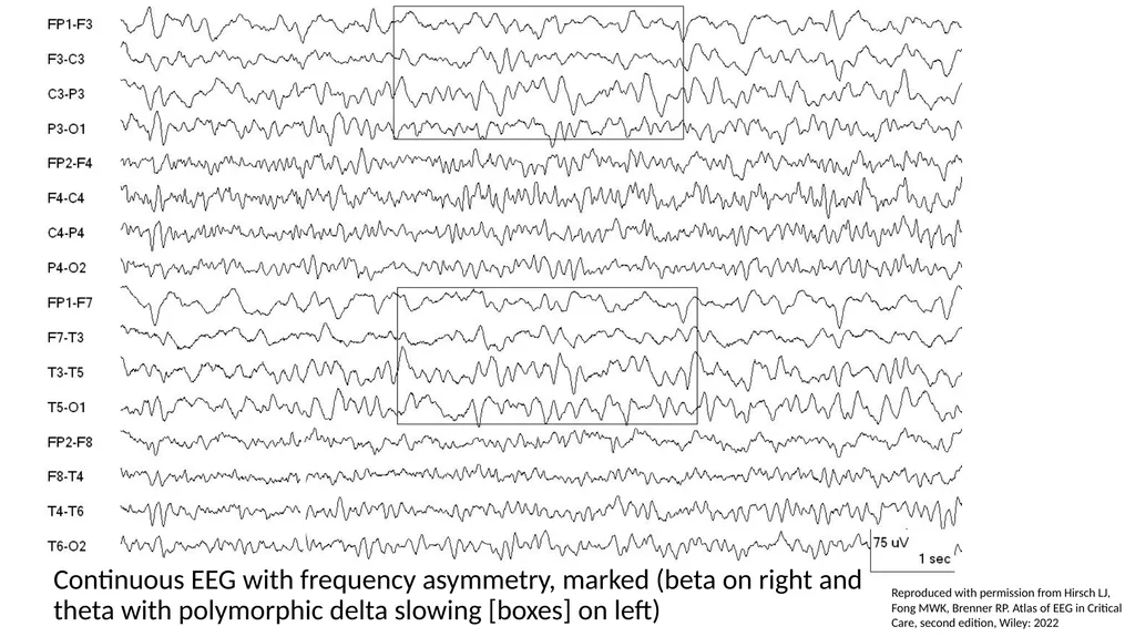 ACNS Critical Care EEG Terminology Training Module - slide 12 of 41