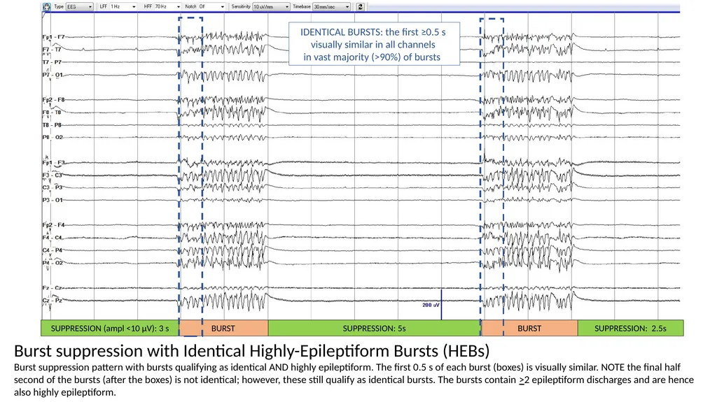 ACNS Critical Care EEG Terminology Training Module - slide 27 of 41