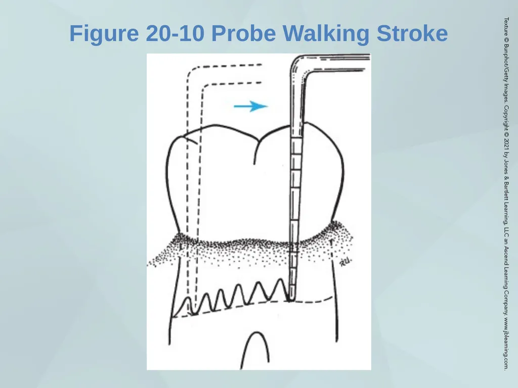 Chapter 20 Periodontal Examination Learning - slide 30 of 49