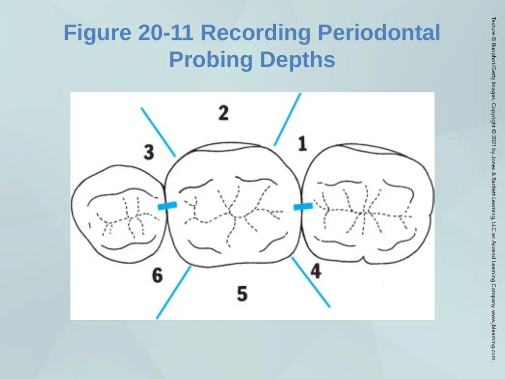 Chapter 20 Periodontal Examination Learning - slide 31 of 49