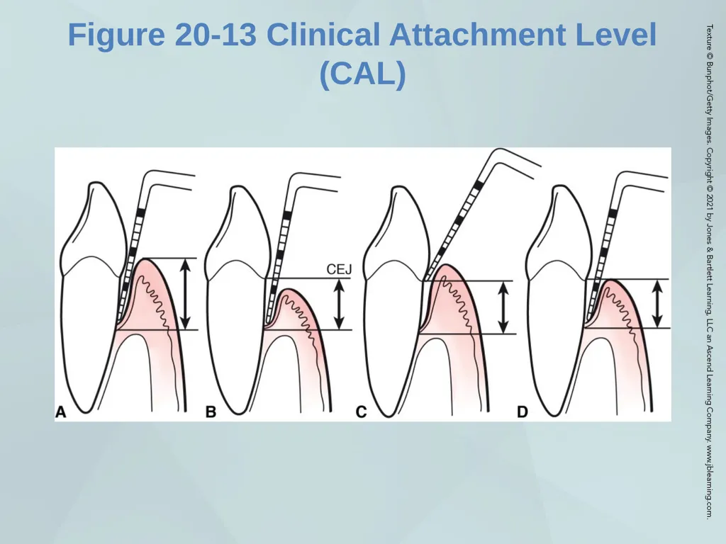 Chapter 20 Periodontal Examination Learning - slide 33 of 49